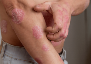 clinically trials psoriasis clinical trial now enrolling san francisco clinically trials psoriasis clinical trial now enrolling san francisco